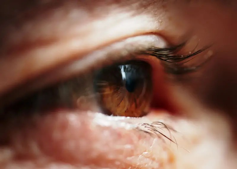 एका महिलेच्या पापण्यांमध्ये 250 उवा आणि त्यांची 85 अंडी, ज्या काढण्यासाठी दोन तास लागले: